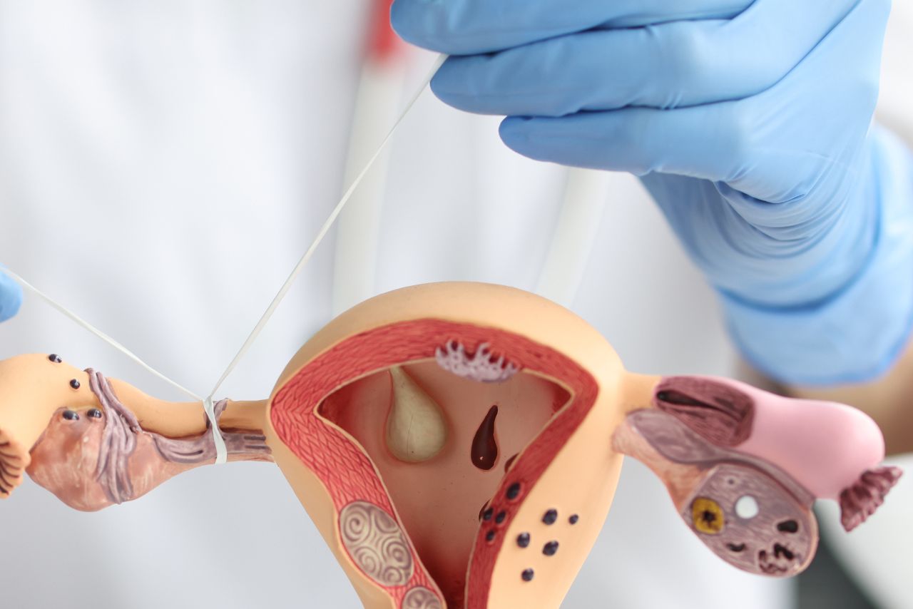 Bilateral Tubal Blockage