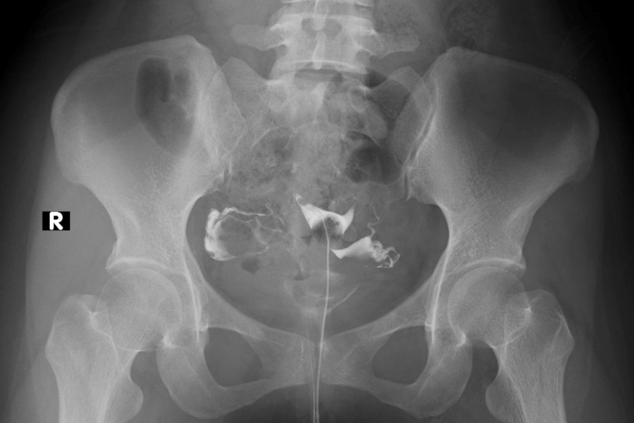 Hysterosalpingography